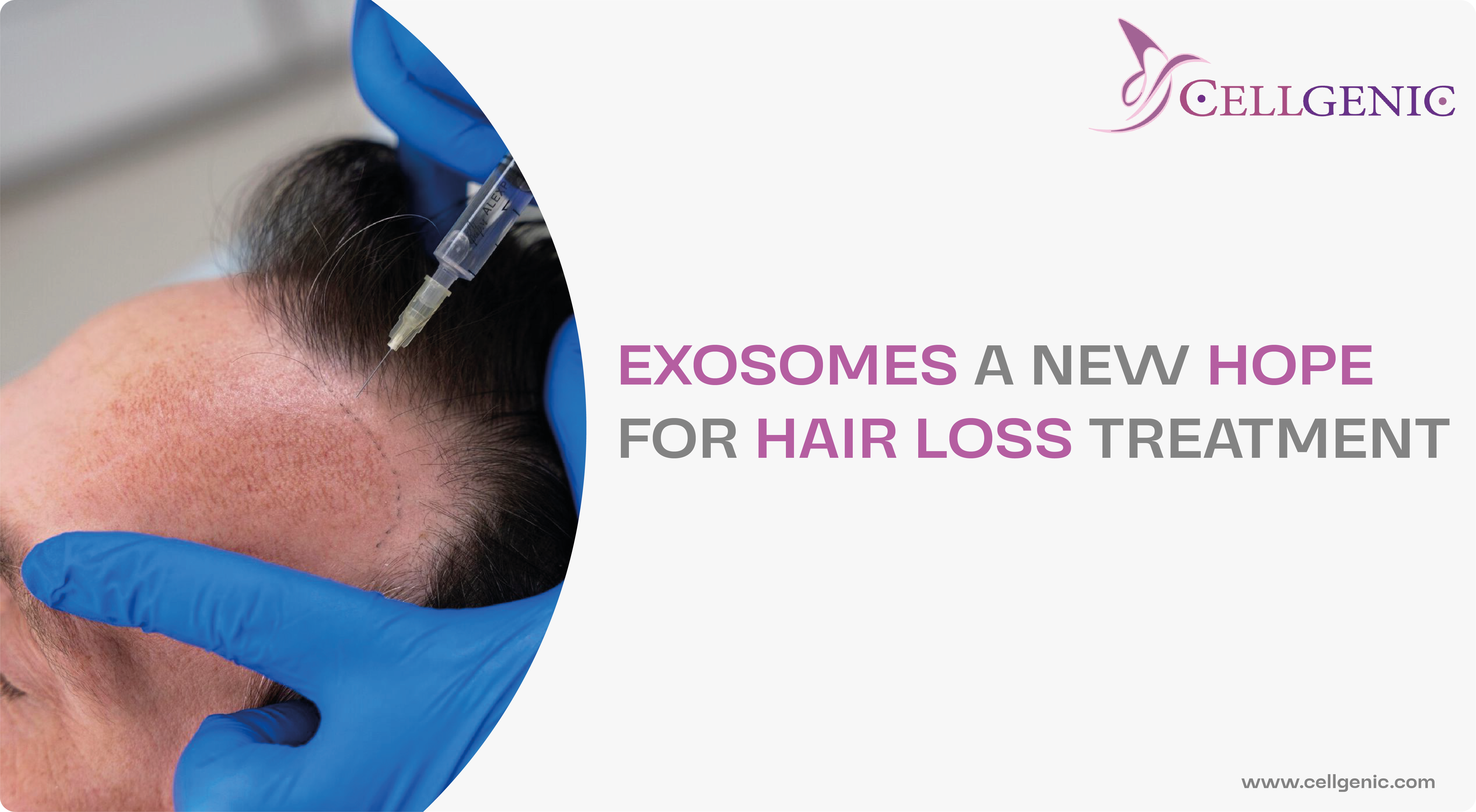 Exosomes: A New Hope for Hair Loss Treatment